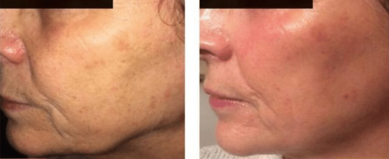 AlumierMD Chemical Peels