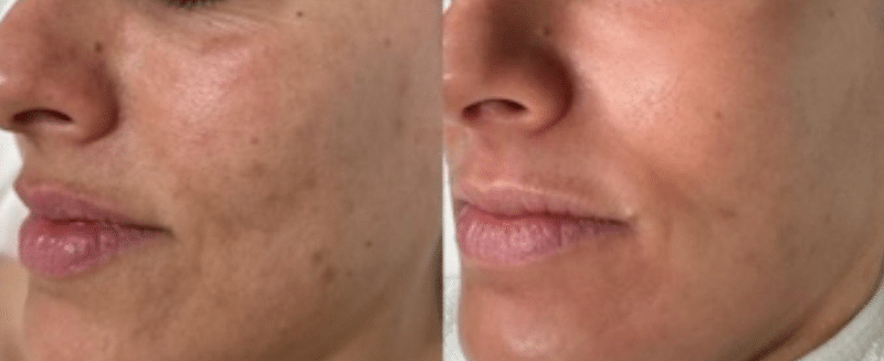 AlumierMD Chemical Peels