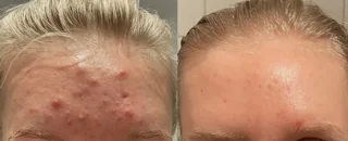 Before and after Alumiermd Chemical Peel