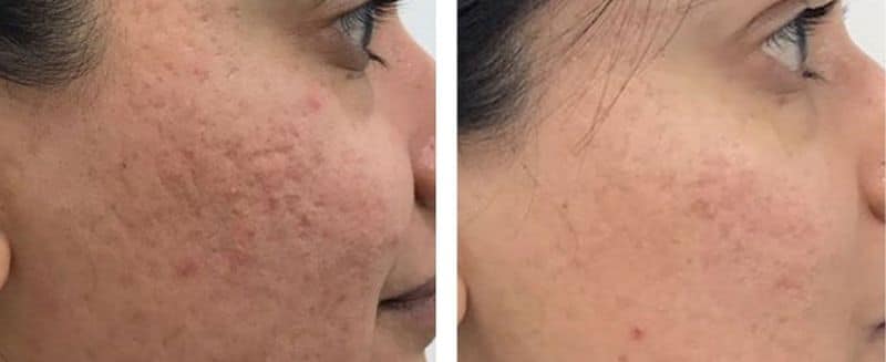 AlumierMD Chemical Peels