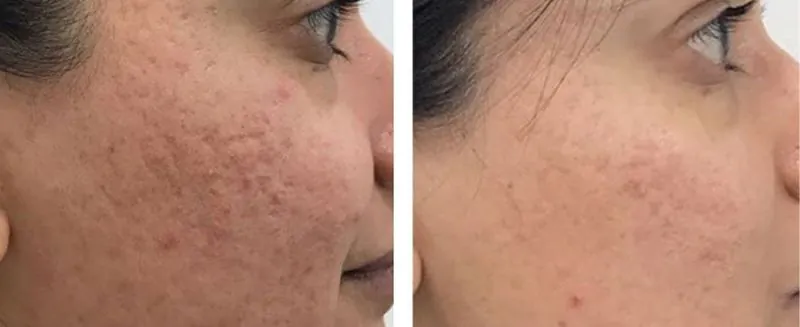 Alumiermd pigmentation Treatment Newcastle