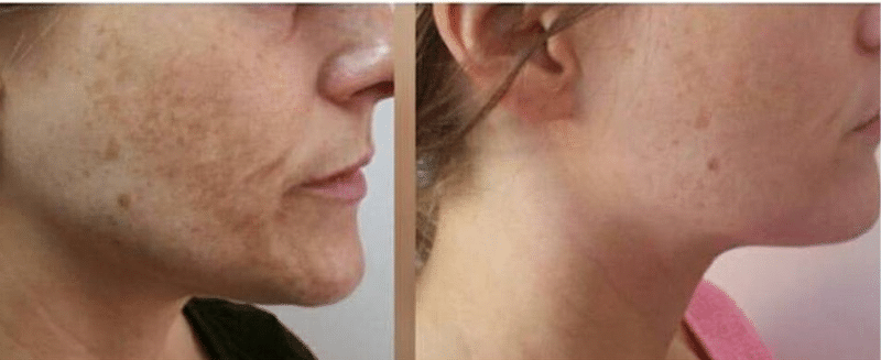 AlumierMD Chemical Peels