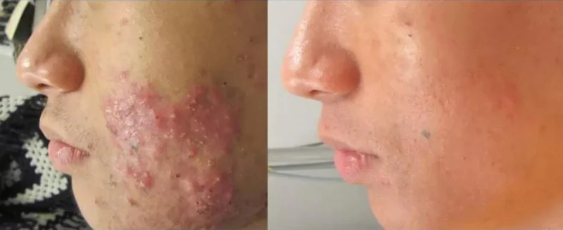 Acne skin treatment newcastle face