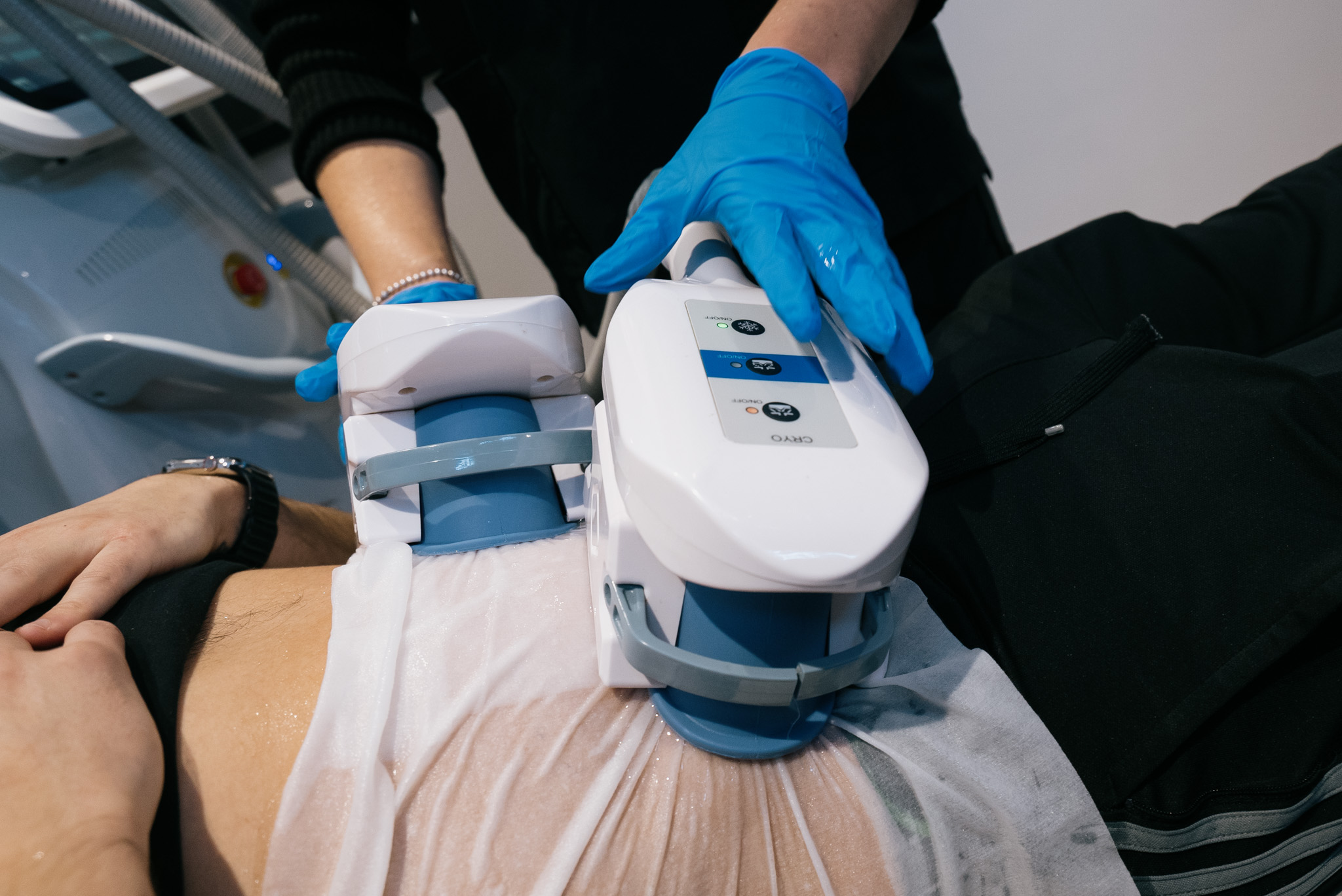 Cryolipolysis Newcastle