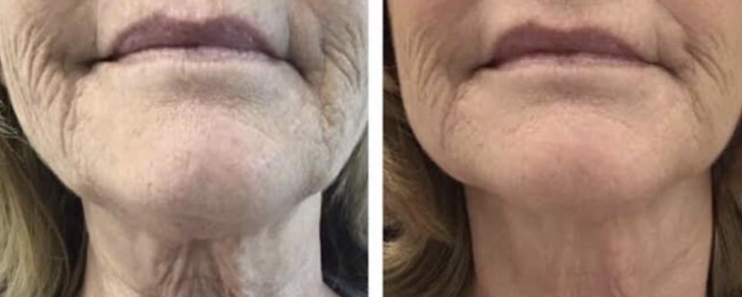 Treatments for Wrinkles