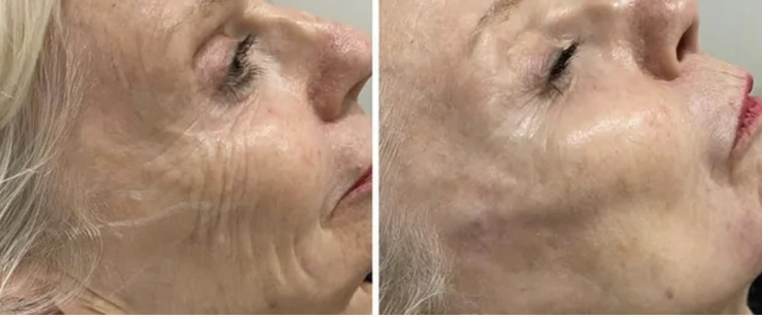 Treatments for Wrinkles