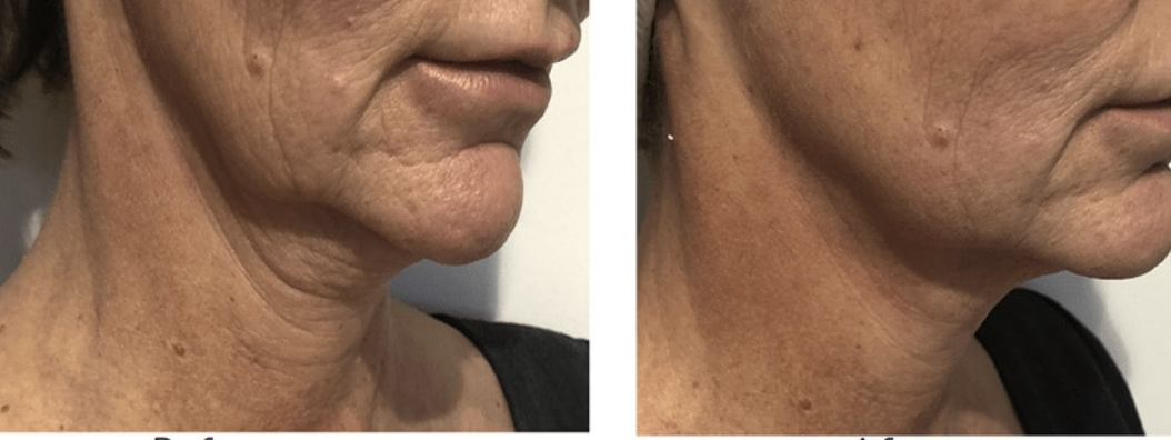 Treatments for Wrinkles