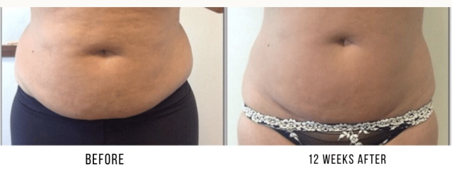 Treatment for Postpartum Body